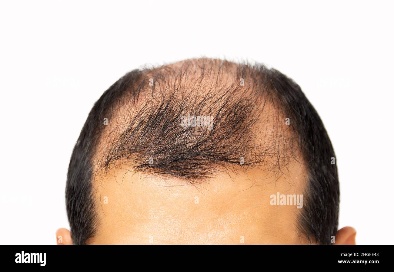 La perdita di capelli concetto. Testa di uomo su sfondo bianco, primo piano Foto Stock
