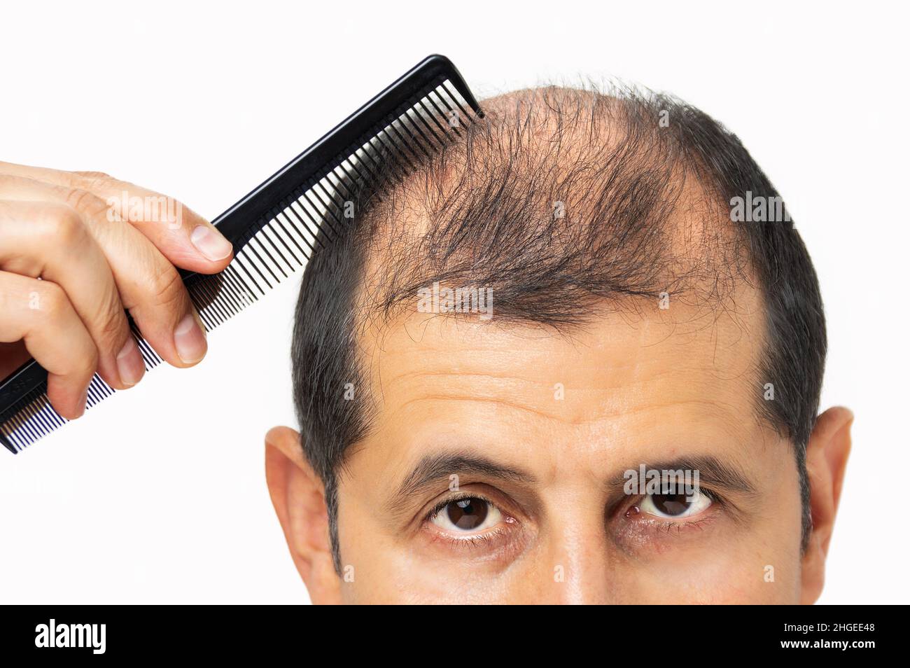Alopecia umana o perdita di capelli - uomo adulto che tiene il pettine sulla testa del calvo Foto Stock
