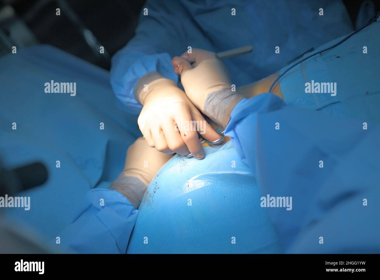 Processo di intervento chirurgico della prima persona nell'OT. Foto Stock