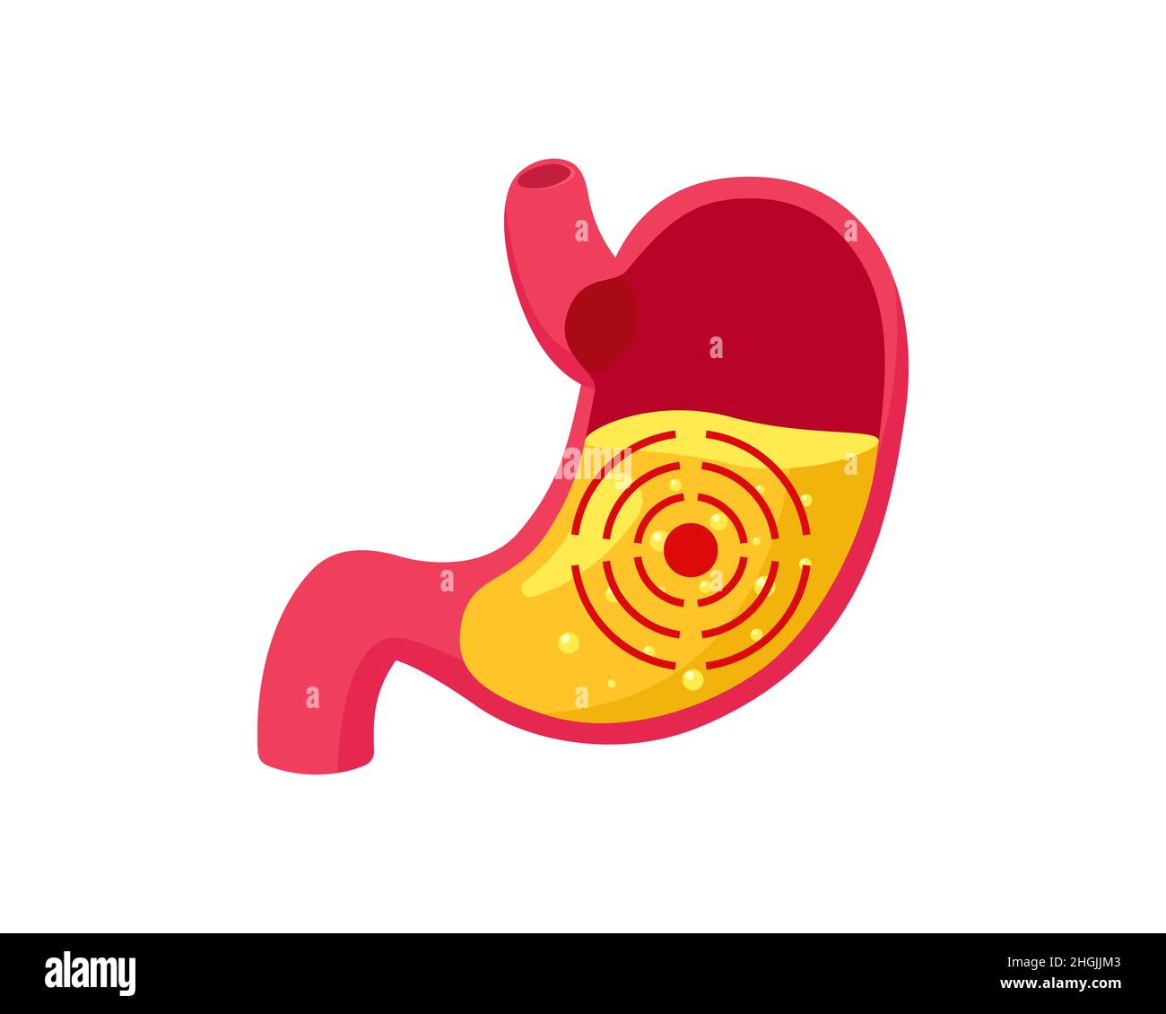 Ulcera gastrica con succo gastrico all'interno e bersaglio. Problema di gastrite del sistema digestivo. Indigestione e malattia del ventre. Dolore addominale gastrico. Illustrazione eps vettore medico Illustrazione Vettoriale