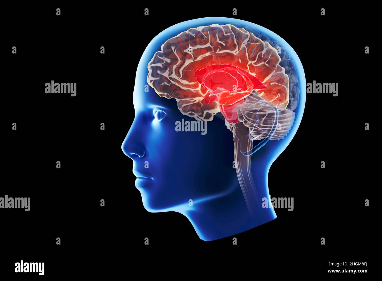 Malattia di Alzheimer che colpisce l'ippocampo, illustrazione Foto Stock