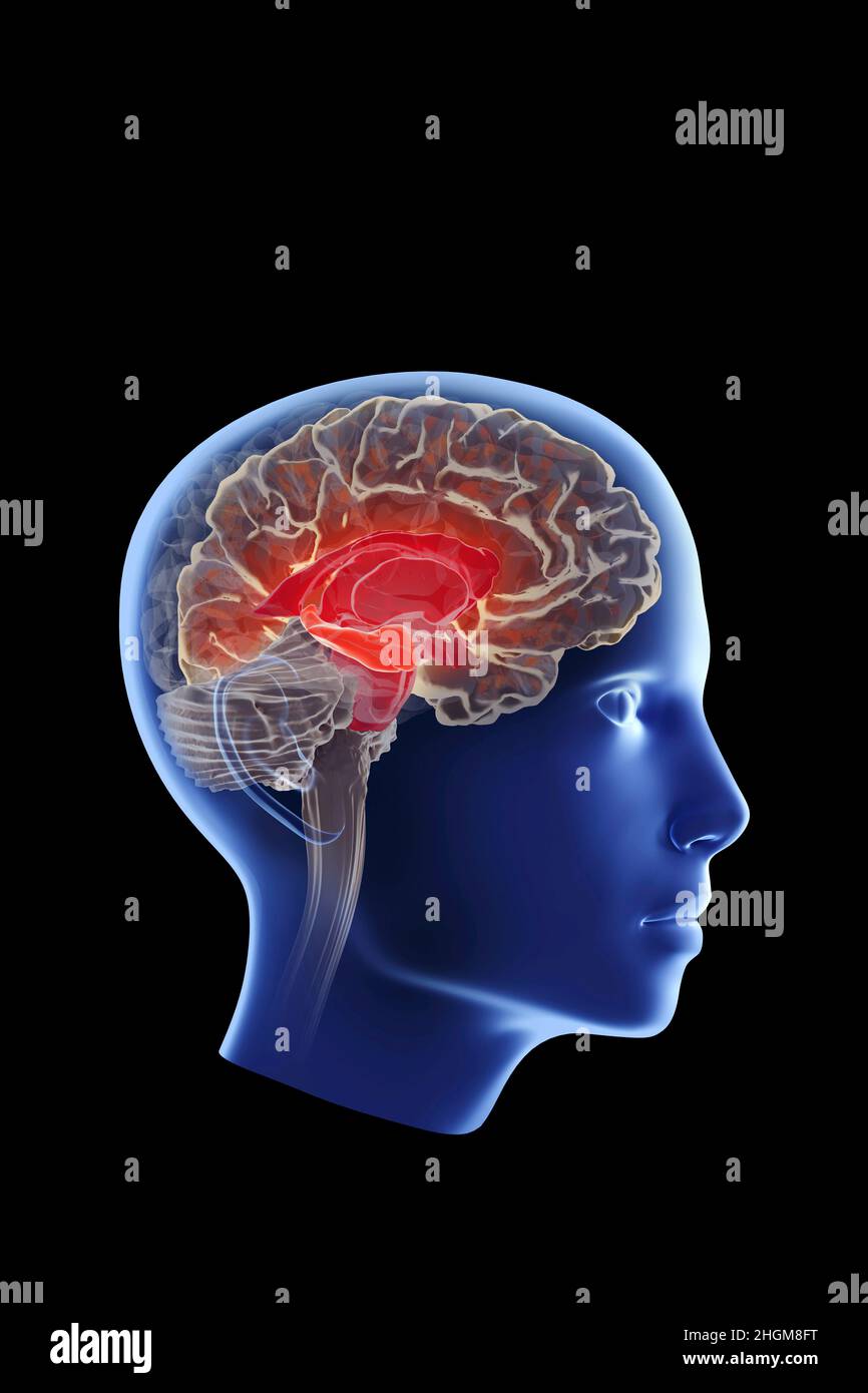 Malattia di Alzheimer che colpisce l'ippocampo, illustrazione Foto Stock