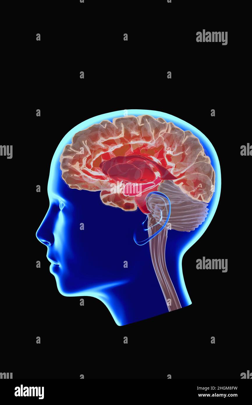 Malattia di Alzheimer che colpisce l'ippocampo, illustrazione Foto Stock