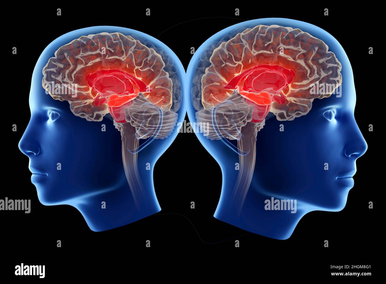 Malattia di Alzheimer che colpisce l'ippocampo, illustrazione Foto Stock