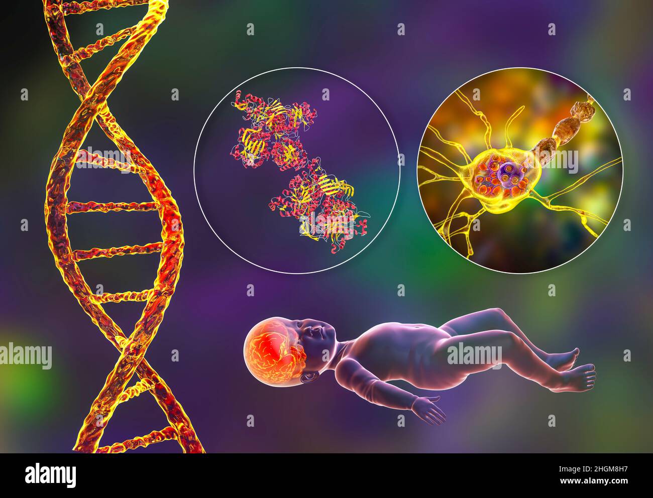 Malattia di Tay-Sachs, illustrazione del calcolatore Foto Stock