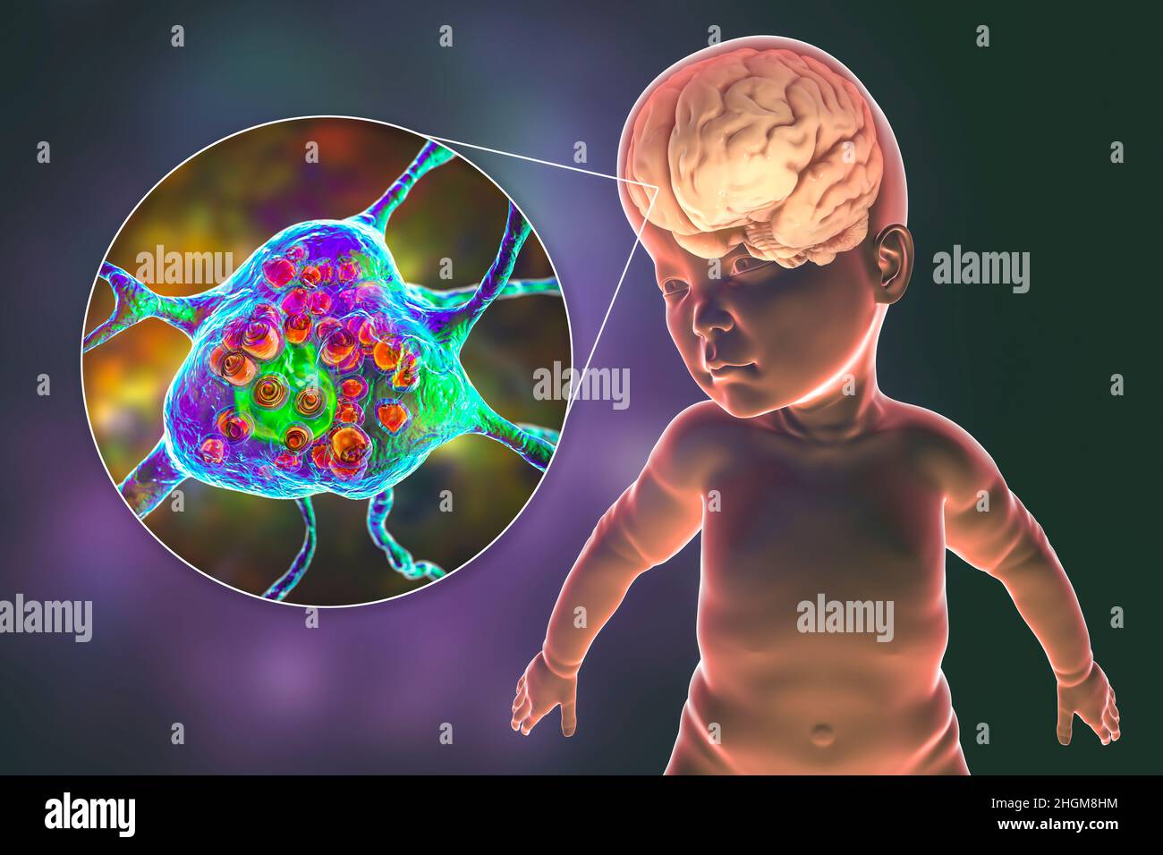 Malattia di Tay-Sachs, illustrazione del calcolatore Foto Stock