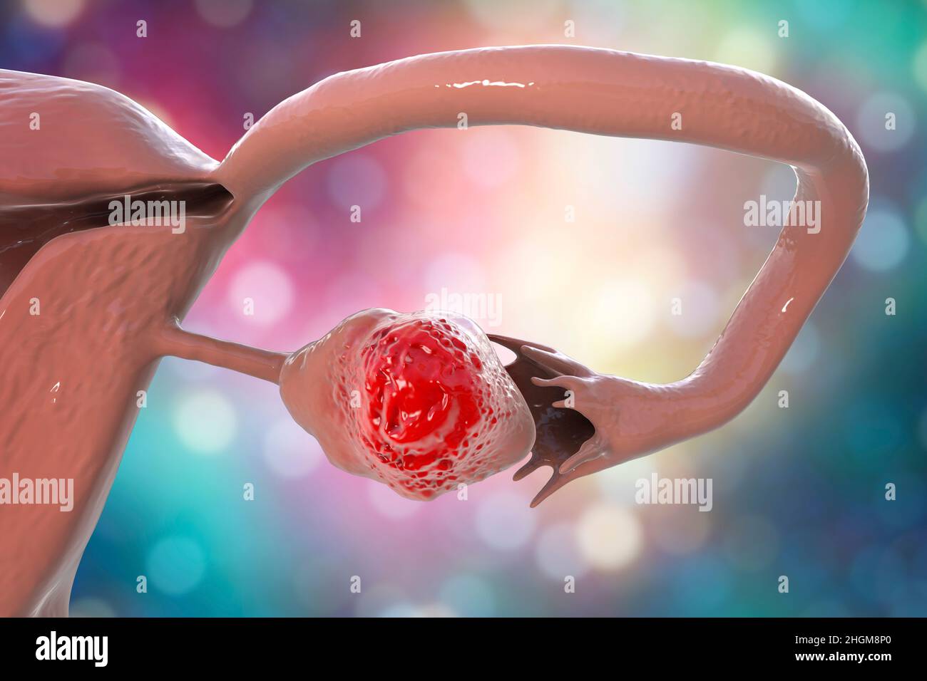Cancro ovarico, illustrazione Foto Stock