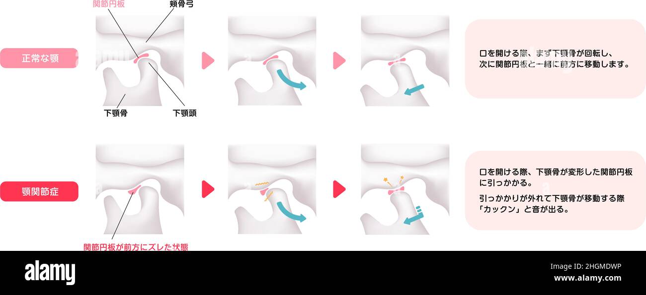 Illustrazione comparativa della mandibola normale e dei disturbi del temporomandibolo (TMD) Illustrazione Vettoriale