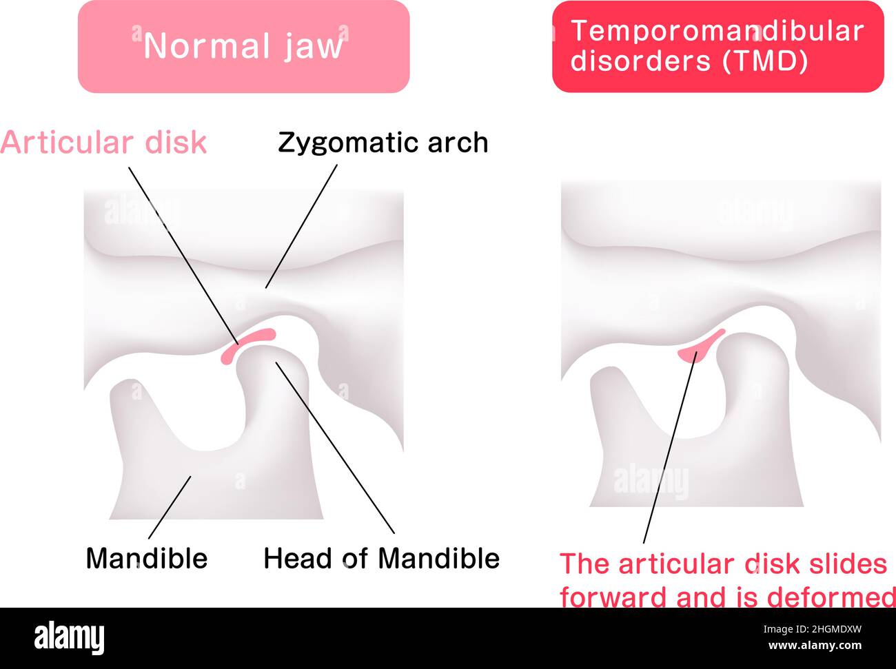 Illustrazione comparazione delle forme del disco articolare ( mascella normale e disturbi temporomandibolari ) Illustrazione Vettoriale