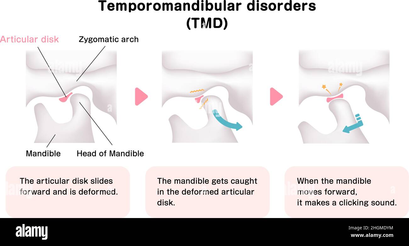 Illustrazione della causa dei disturbi temporomandibolari (TMD) Illustrazione Vettoriale