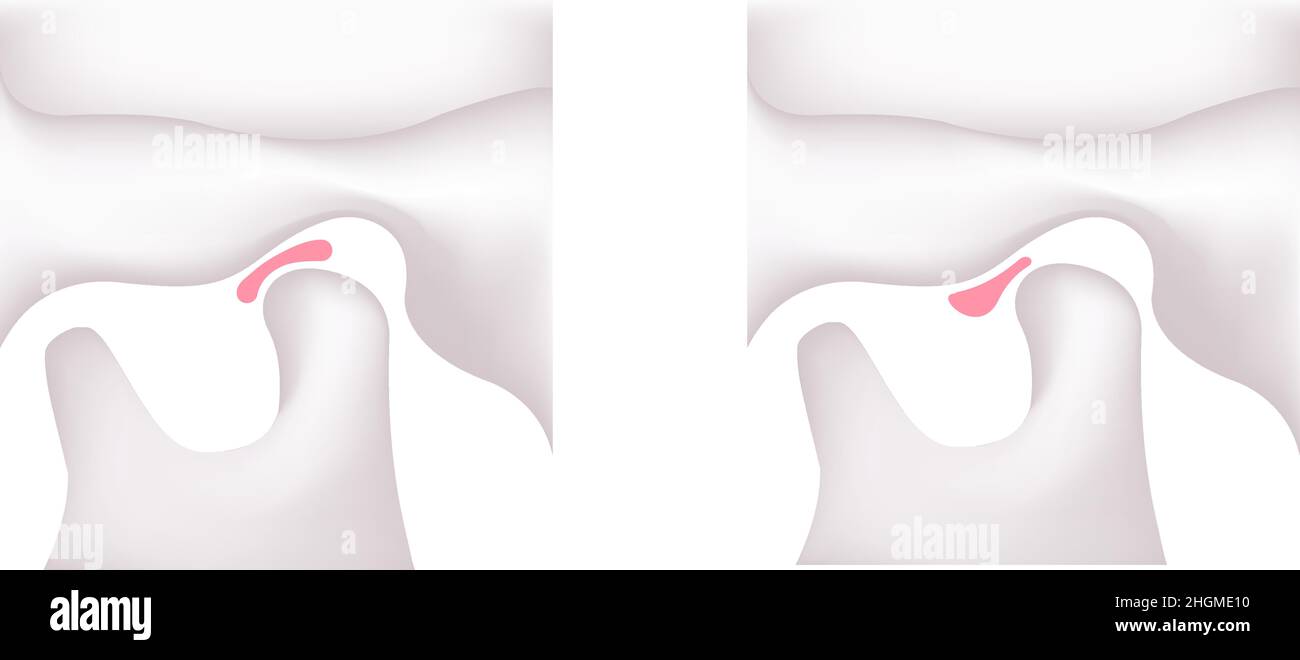 Illustrazione comparazione delle forme del disco articolare ( mascella normale e disturbi temporomandibolari ) Illustrazione Vettoriale