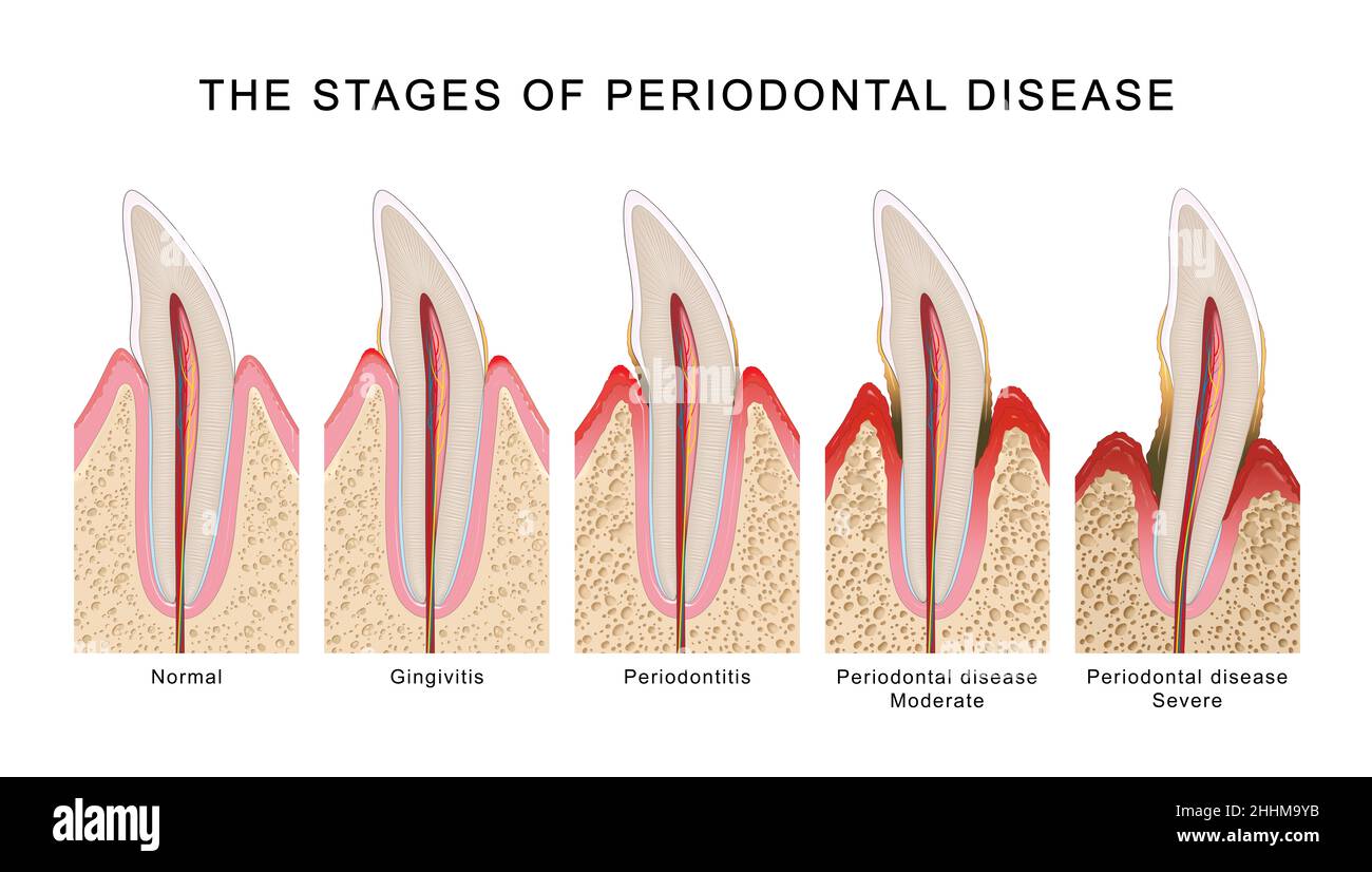 Le fasi della malattia periodontale Foto Stock