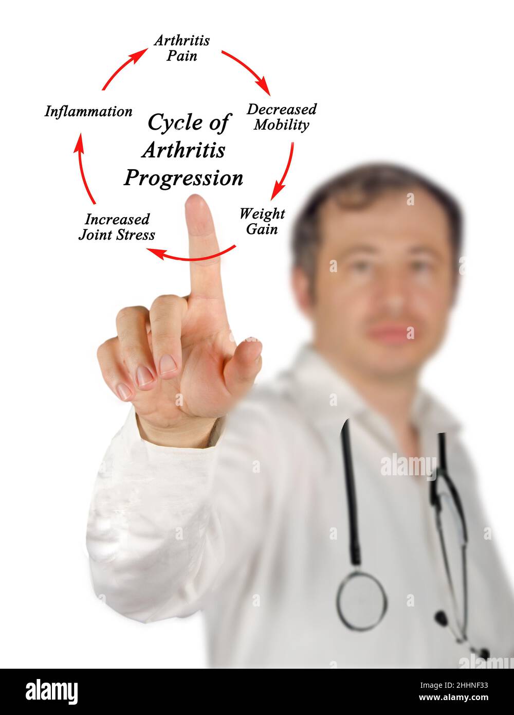 Le fasi nel ciclo di artrite progressione Foto Stock