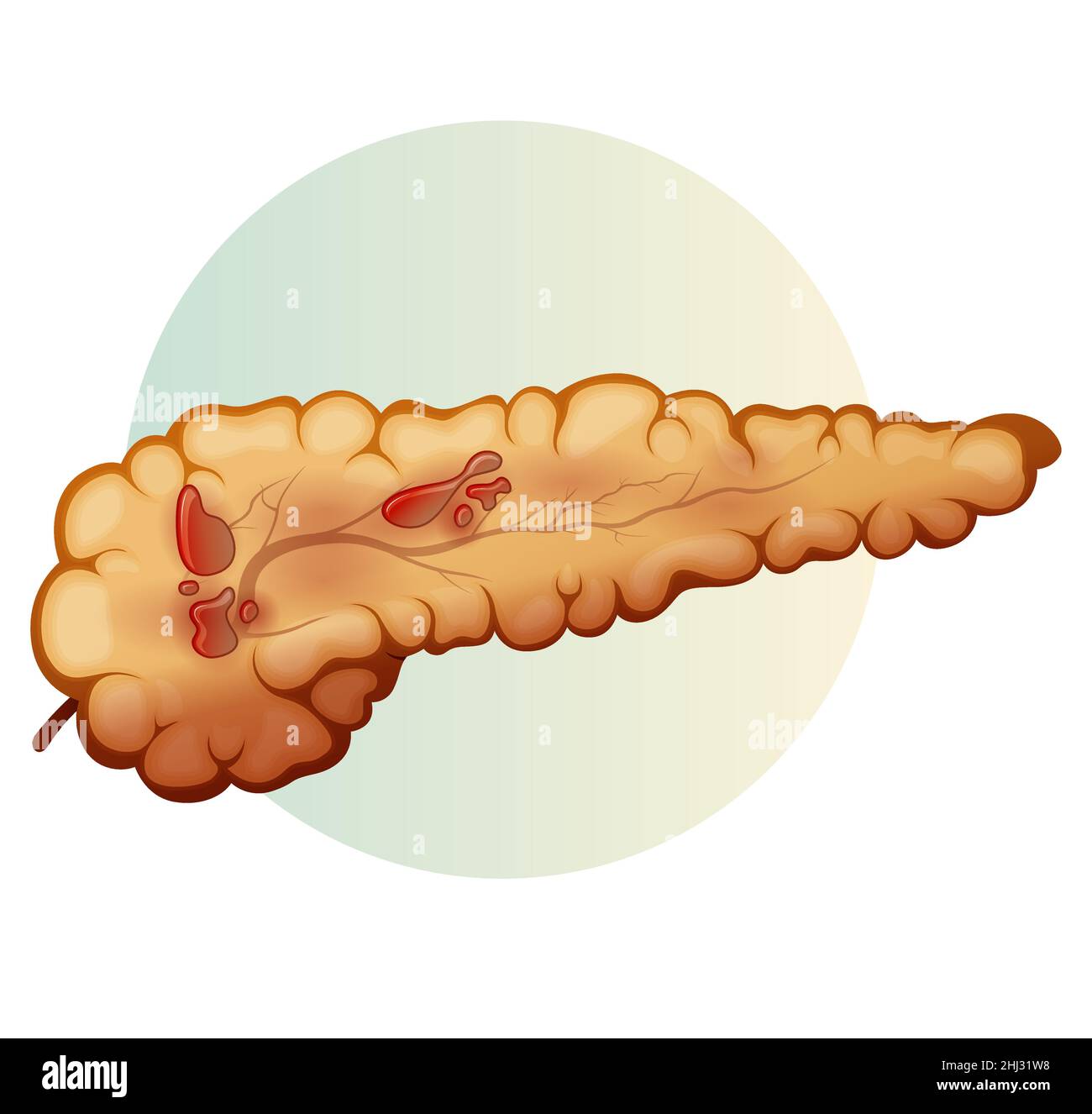 Pancreas - pancreatite acuta - Stock Illustration as EPS 10 file Illustrazione Vettoriale