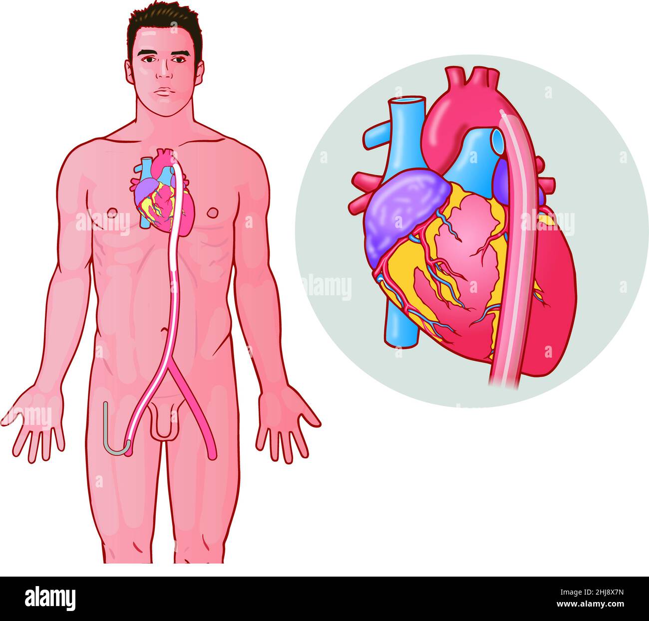 Uno dei tre in una serie di diagrammi di arte medica che mostrano come un dispositivo di terapia della pompa intra-aortica del palloncino (IABP) è allegato argomenti di biologia educativa Foto Stock