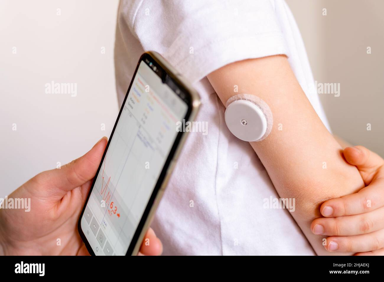 CGM - sistema di monitoraggio continuo del glucosio sul braccio del bambino. Foto Stock