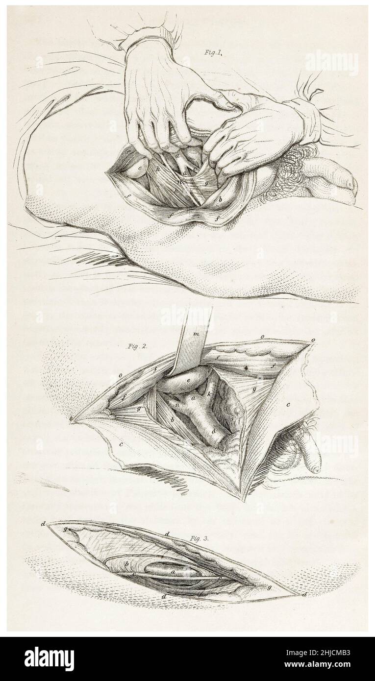 Tre diagrammi che mostrano l'arteria femorale. L'arteria femorale è un'arteria grande nella coscia. John Lizars, 1847. Foto Stock