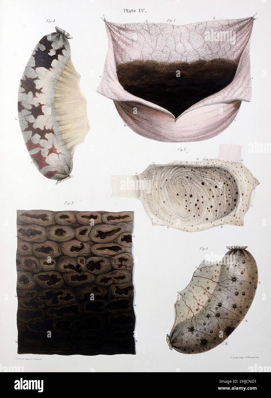 Melanoma nel sangue e nello stomaco, 1838. Da "Anatomia patologica: Illustrazioni delle forme elementari di malattia", di Sir Robert Carswell. Foto Stock