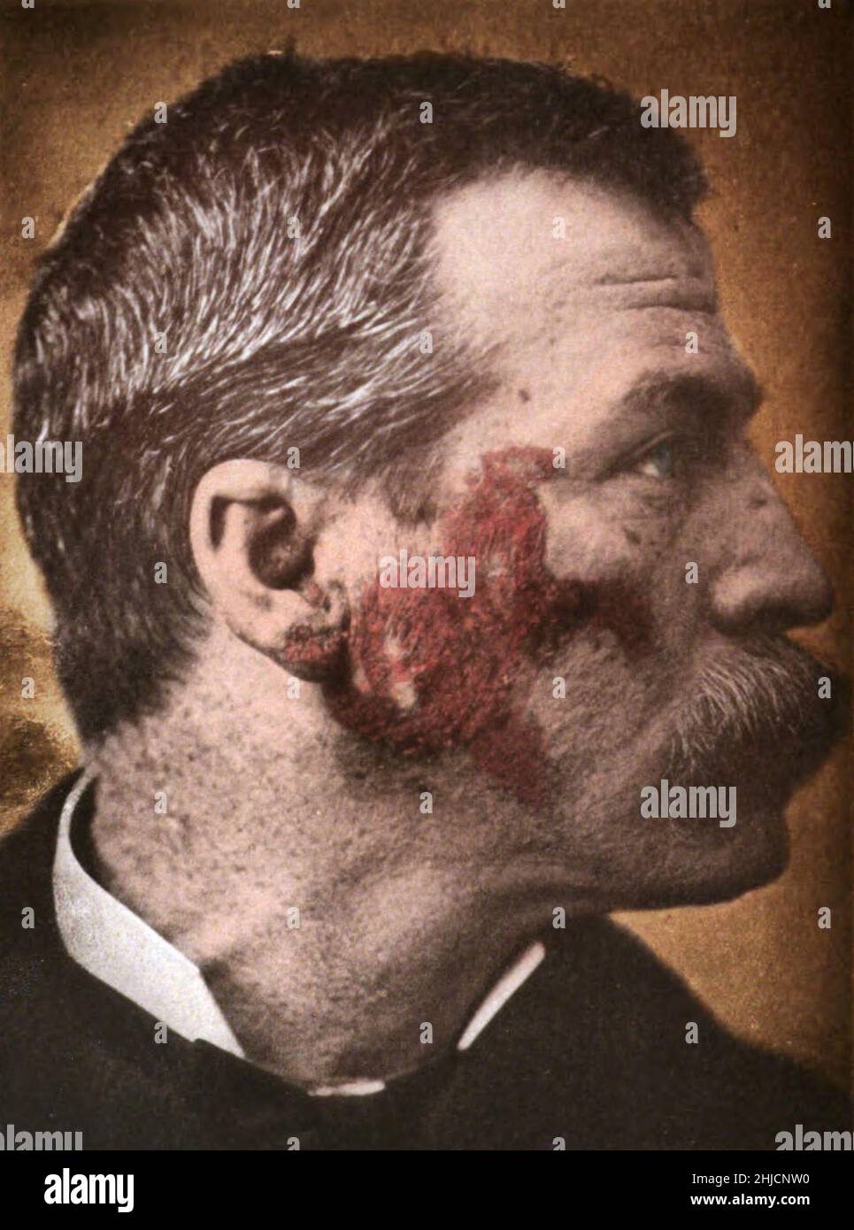 Lupus eritematoso, una malattia autoimmune. Si tratta di una malattia infiammatoria causata quando il sistema immunitario attacca i propri tessuti. Fotografato da George Henry Fox, 1886. Foto Stock