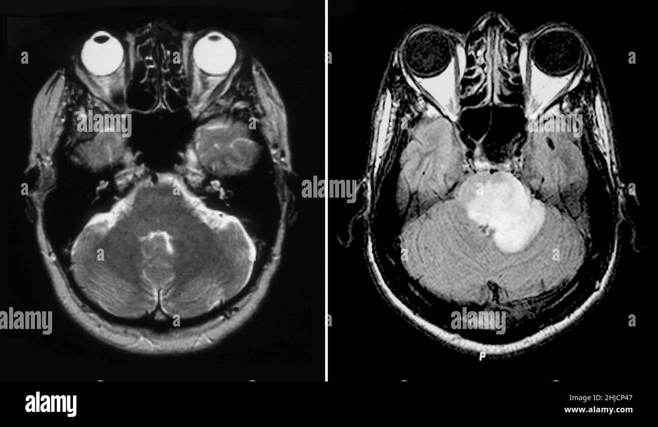 MRI del cervello normale (sinistra) e uno con sclerosi multipla acuta (destra). A sinistra si trova una scansione MRI, con T2 pesate, vista assiale attraverso il cervello di una femmina di 54 anni. A destra si trova un'immagine MRI assiale del cervello attraverso il livello del tronco cerebrale, rivelando un edema esteso e l'allargamento del pons che si estende nel peduncolo cerebellare centrale sinistro (a destra). Sulle immagini post-contrasto è presente un miglioramento dell'anello sporgente. Questo rappresenta una forma di SM acuta che può stimolare un tumore; pertanto, è indicato come tumefactive. Foto Stock