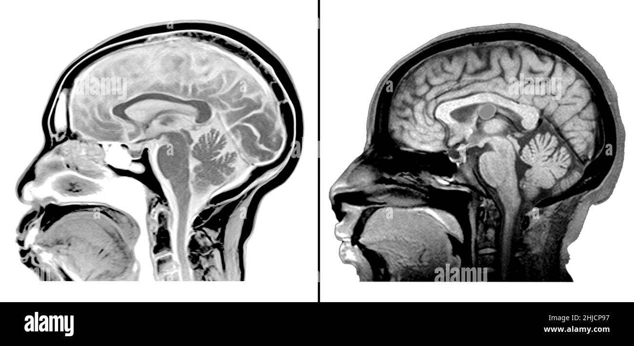 RM (vista sagittale) del cervello normale (sinistra) e una che mostra una cisti colloidale del terzo ventricolo (destra). Una cisti colloidale è una cisti contenente materiale gelatinoso nel cervello. A causa della sua posizione, può causare l'idrocefalo ostruttivo e l'aumento della pressione intracranica. Queste cisti rappresentano circa il 1% di tutti i tumori intracranici e possono causare cefalea, vertigini, deficit di memoria, diplopia, disturbi comportamentali e, in casi estremi, morte improvvisa. Foto Stock