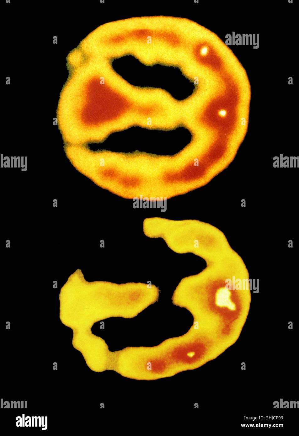 Due scansioni PET di un cervello umano normale (in alto) e una affetta dalla malattia di Alzheimer (in basso). Foto Stock
