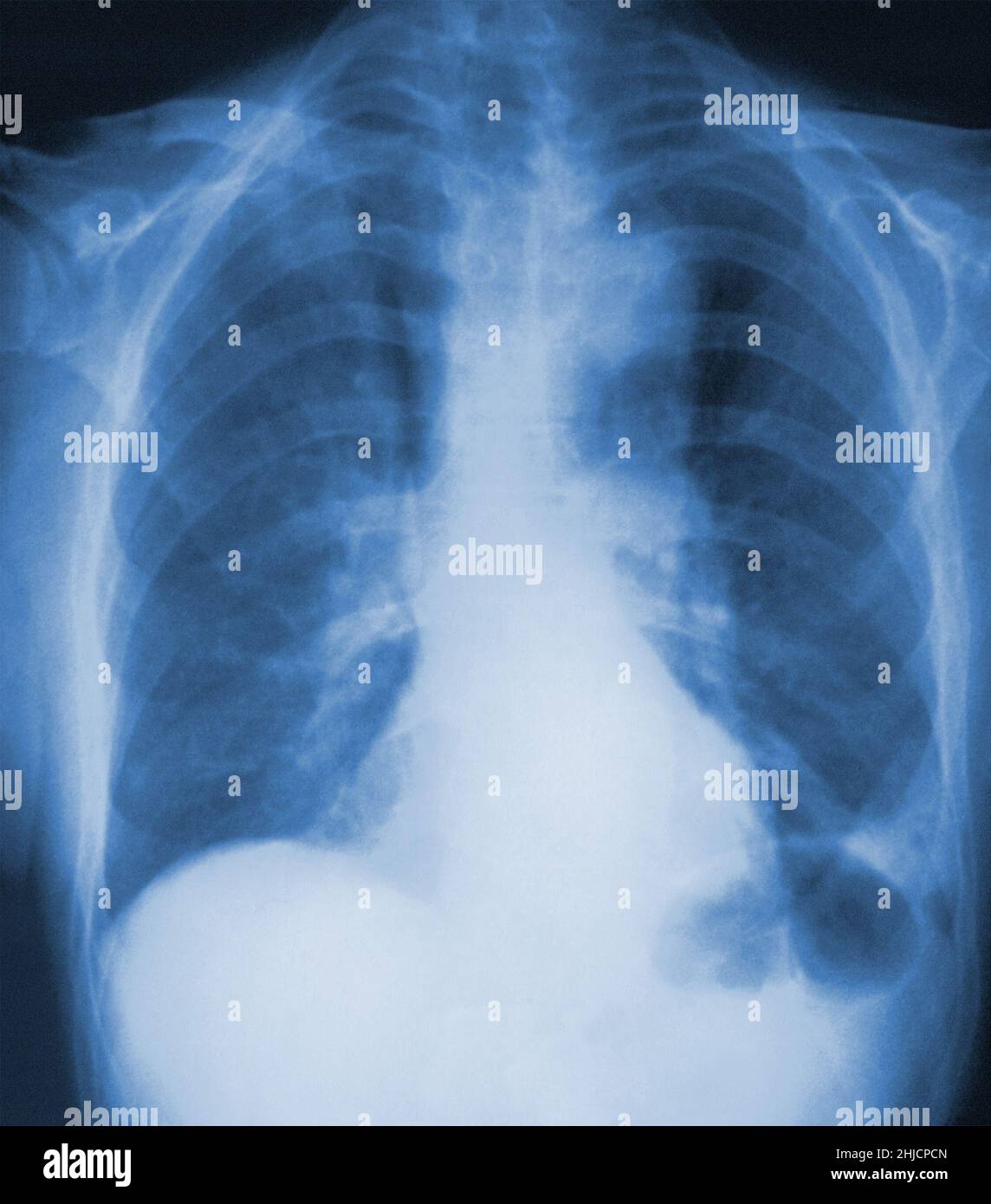 Questa radiografia anteroposteriore del 1976 ha rivelato infiltrati polmonari bilaterali in un paziente con malattia di Legionnaires. La malattia di Legionnaires è stata scoperta dopo un'epidemia ad una convenzione di Filadelfia della legione americana in 1976. È un tipo di polmonite causata dai batteri della Legionella pneumophila. Colore ottimizzato. Foto Stock