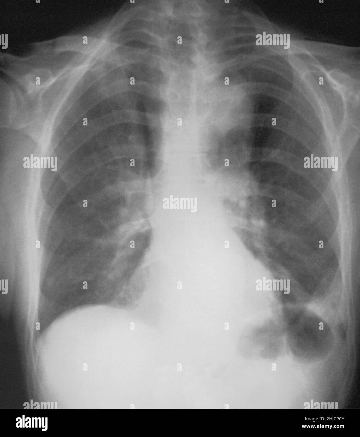 Questa radiografia anteroposteriore del 1976 ha rivelato infiltrati polmonari bilaterali in un paziente con malattia di Legionnaires. La malattia di Legionnaires è stata scoperta dopo un'epidemia ad una convenzione di Filadelfia della legione americana in 1976. È un tipo di polmonite causata dai batteri della Legionella pneumophila. Foto Stock