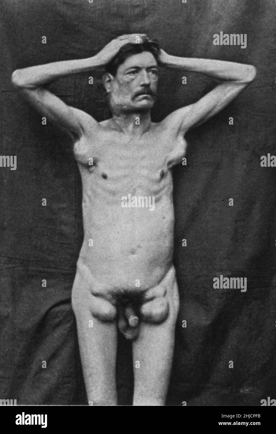 Uomo adulto colpito dal morbo di Hodgkin. Atlante di Medicina Clinica, 1892.il morbo di Hodgkin è un tipo di cancro (malattia neoplastica) caratterizzato da infiammazione cronica progressiva e ingrossamento dei linfonodi del collo, delle ascelle, dell'inguine e della mesenteria, da ingrossamento della milza e occasionalmente del fegato e dei reni, e mediante infiltrazione linfoide lungo i vasi sanguigni. La malattia è più comune negli adolescenti e nei giovani adulti. Il morbo di Hodgkin prende il nome dal suo identificatore, il patologo inglese Thomas Hodgkin (1798-1866). Foto Stock