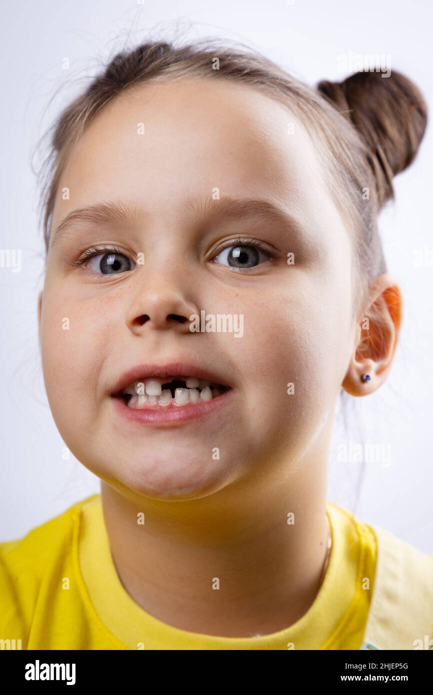 Incantevole faccia femmina con bocca aperta che mostra il dente del bambino mancante in t-shirt gialla su sfondo bianco. Sostituzione dei primi denti. In corso Foto Stock