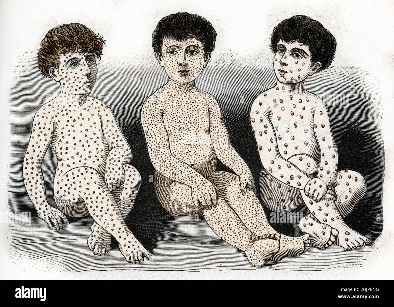 Malattie infantili : trois enfants atteints de rougeole, scarlatine et varicelle - (malattie dell'Infanzia: Tre bambini con morbillo, scarlattina e varicella) gravure tiree de 'Medecine illustrree' 1888 Collection privee Foto Stock