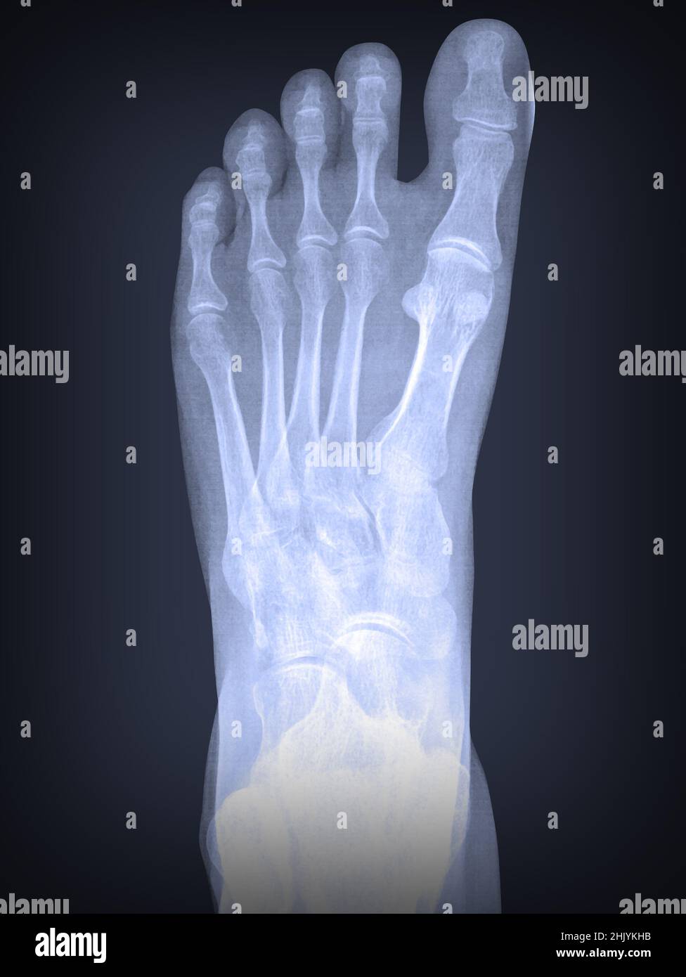 raggi x del piede sinistro con danno da osteoporosi Foto Stock