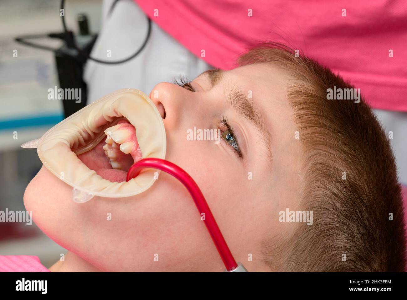 Il bambino siede in una sedia dentale, espulsore di saliva in bocca,  trattamento di carie in un bambino, divaricatore dentale sulle labbra di un  ragazzo Foto stock - Alamy