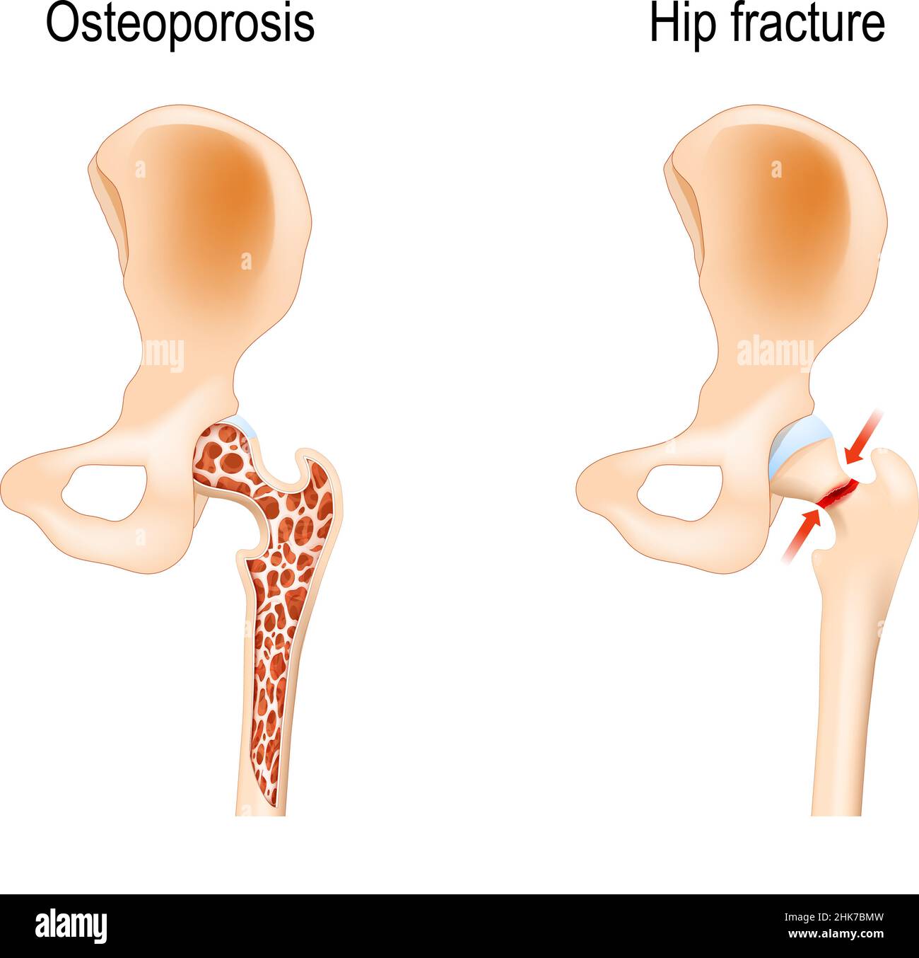 processo di invecchiamento nelle ossa umane. Osteoporosi che ha causato la frattura dell'anca. Illustrazione vettoriale. Poster medico Illustrazione Vettoriale