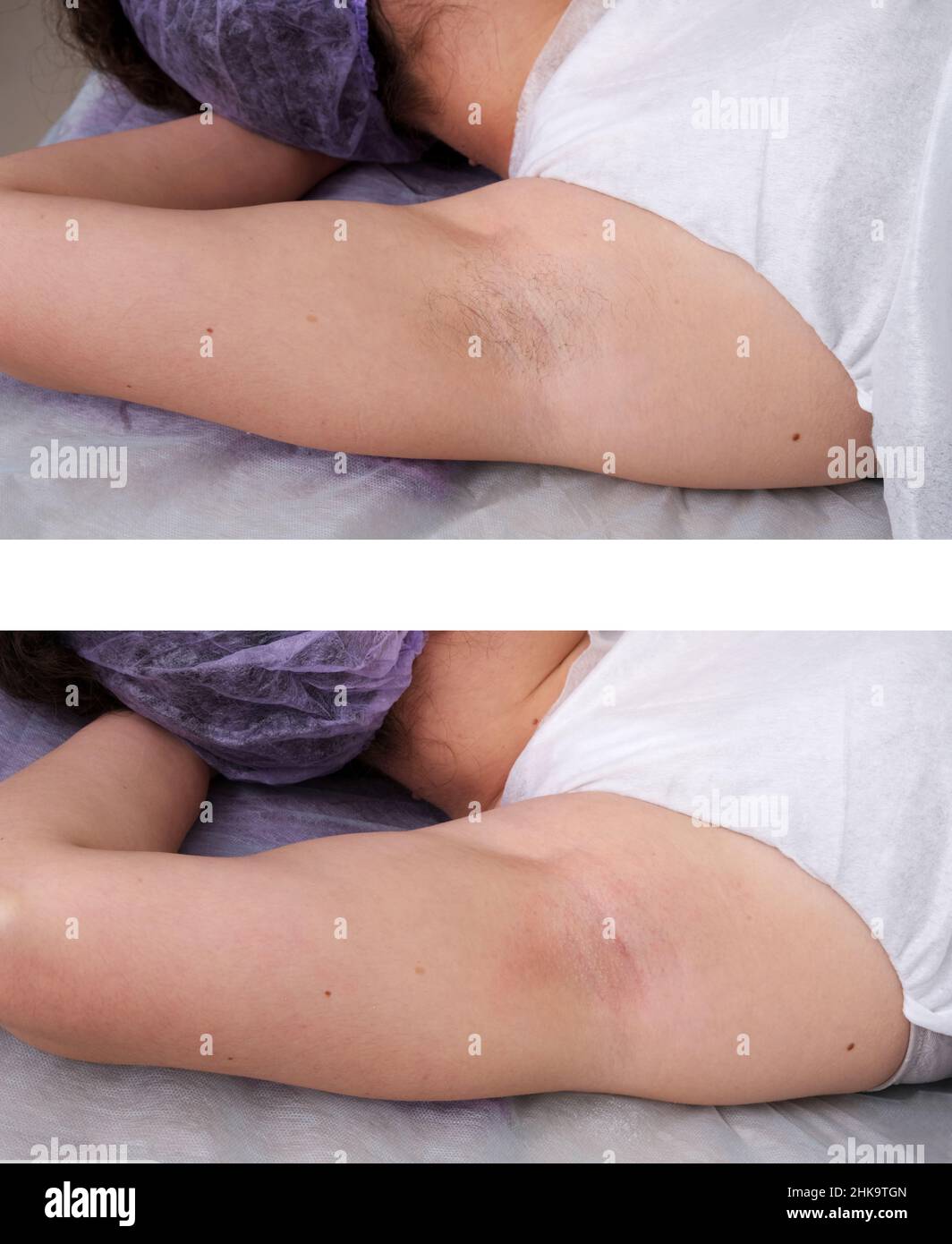 Zona di depilazione ascelle. Prima e dopo. Ceretta e zuccheratura laser  Foto stock - Alamy