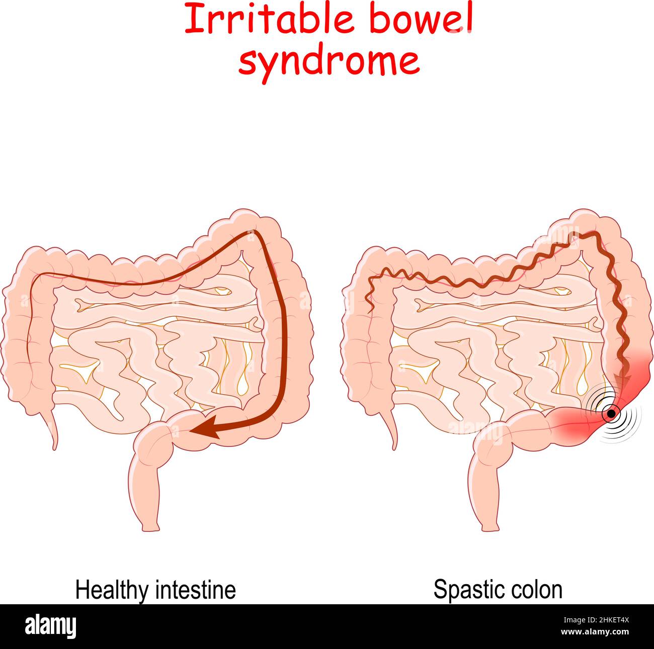 La sindrome dell'intestino irritabile è un disturbo gastrointestinale funzionale. Illustrazione vettoriale Illustrazione Vettoriale