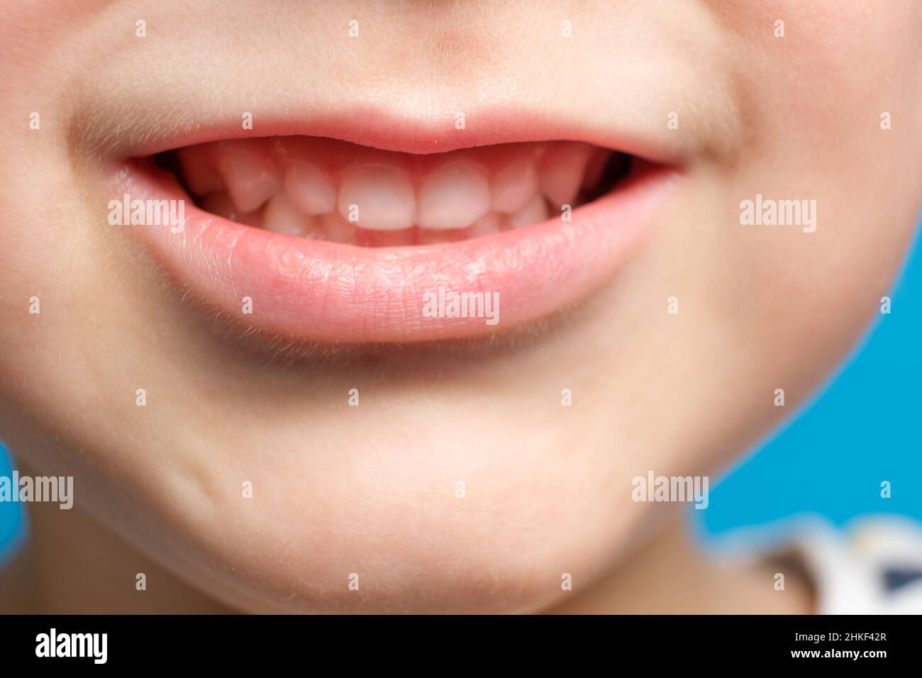 Denti del latte dei bambini in un bambino, bocca aperta, primo piano. Odontoiatria pediatrica, smalto assottigliato Foto Stock