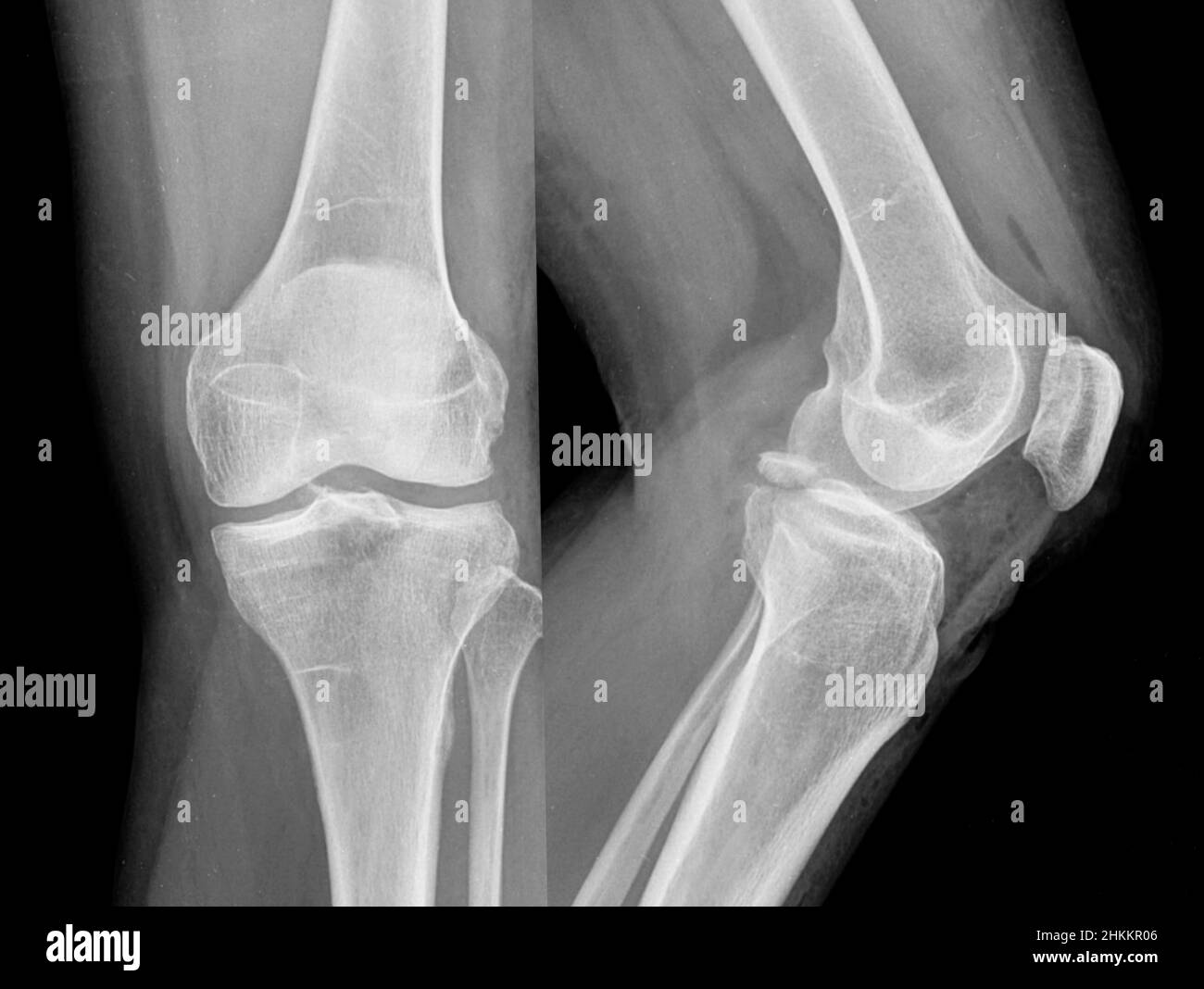Frattura di avulsione del legamento crociato posteriore, raggi X. Foto Stock