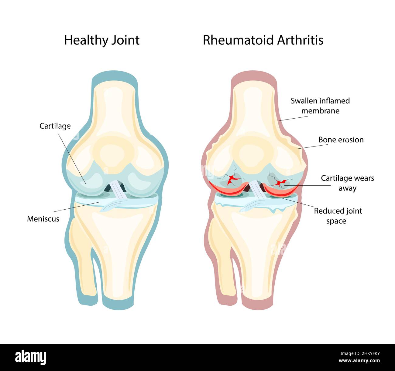 Artrite reumatoide RA che di solito colpisce le ginocchia. La malattia immunitaria automatica. Illustrazione vettoriale Illustrazione Vettoriale