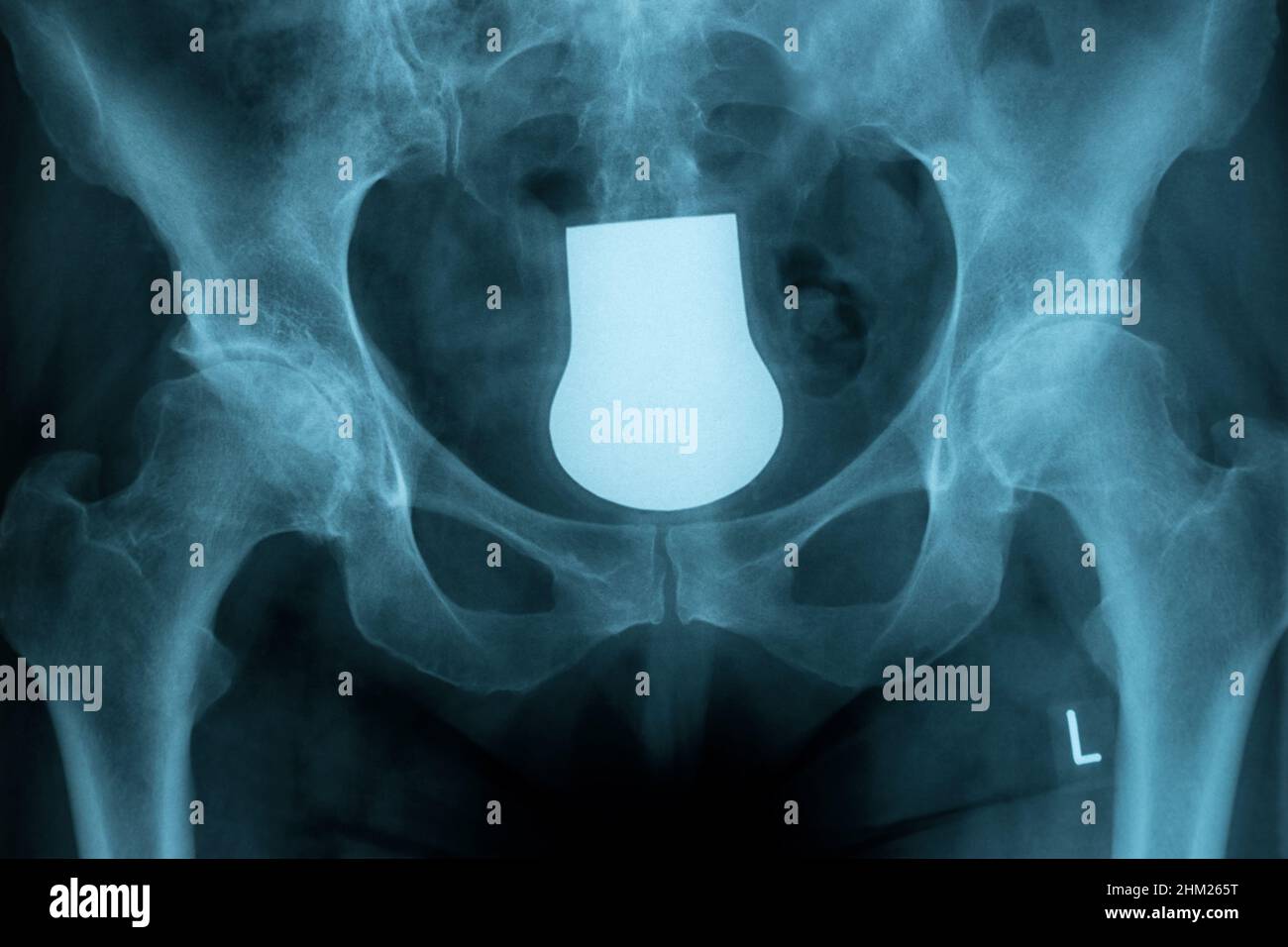 X-ray del bacino e la colonna vertebrale di una donna Foto Stock