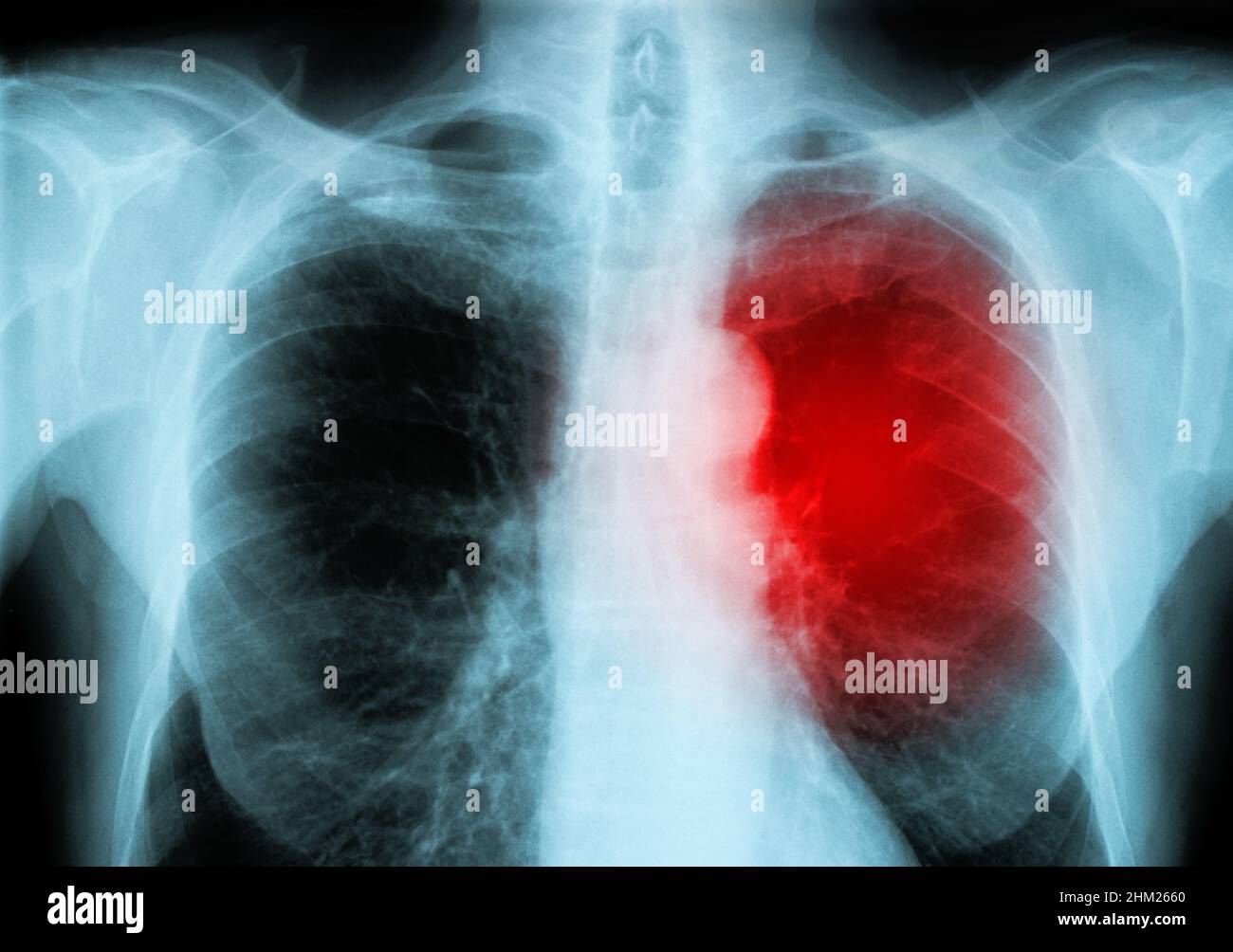 raggi x cuore rosso dell'uomo (malattie cardiache) Foto Stock