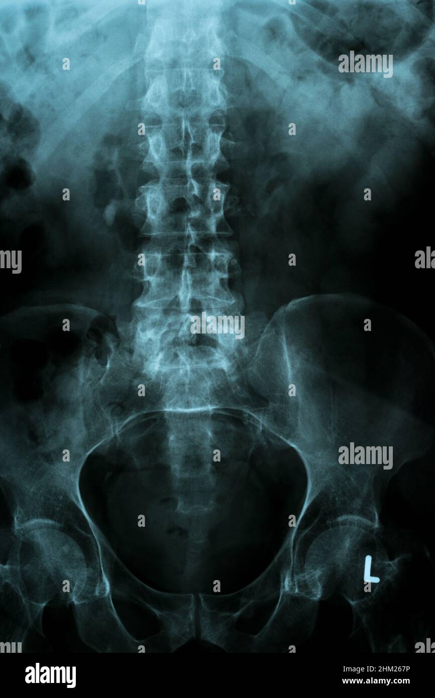 colonna vertebrale e bacino di un corpo umano su un'immagine a raggi x. Foto Stock