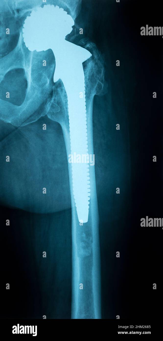 Immagine radiologica di un torace umano con articolazione dell'anca artificiale Foto Stock