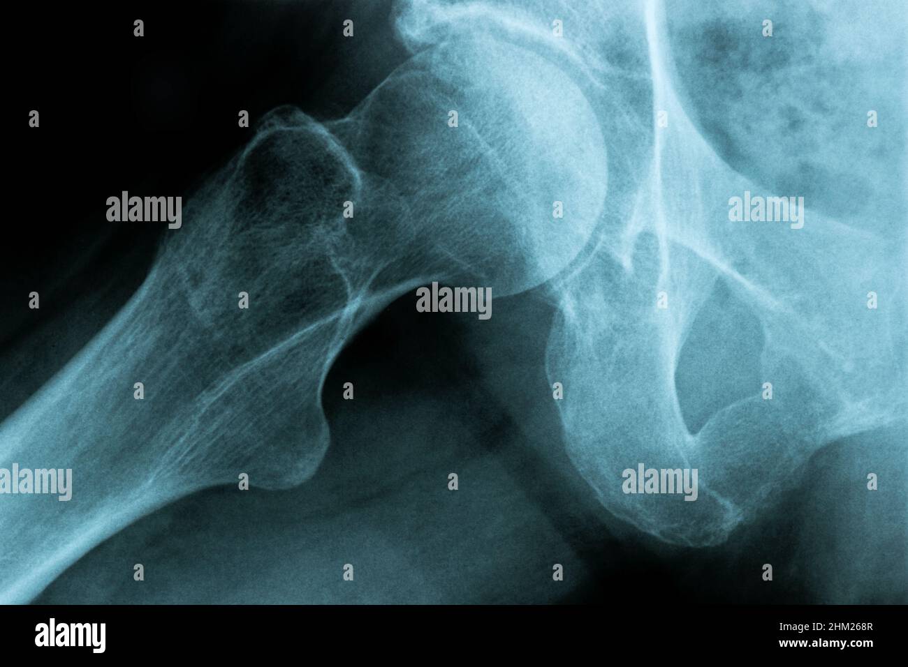 Immagine radiologica di un'articolazione del ginocchio umano per una diagnosi medica Foto Stock