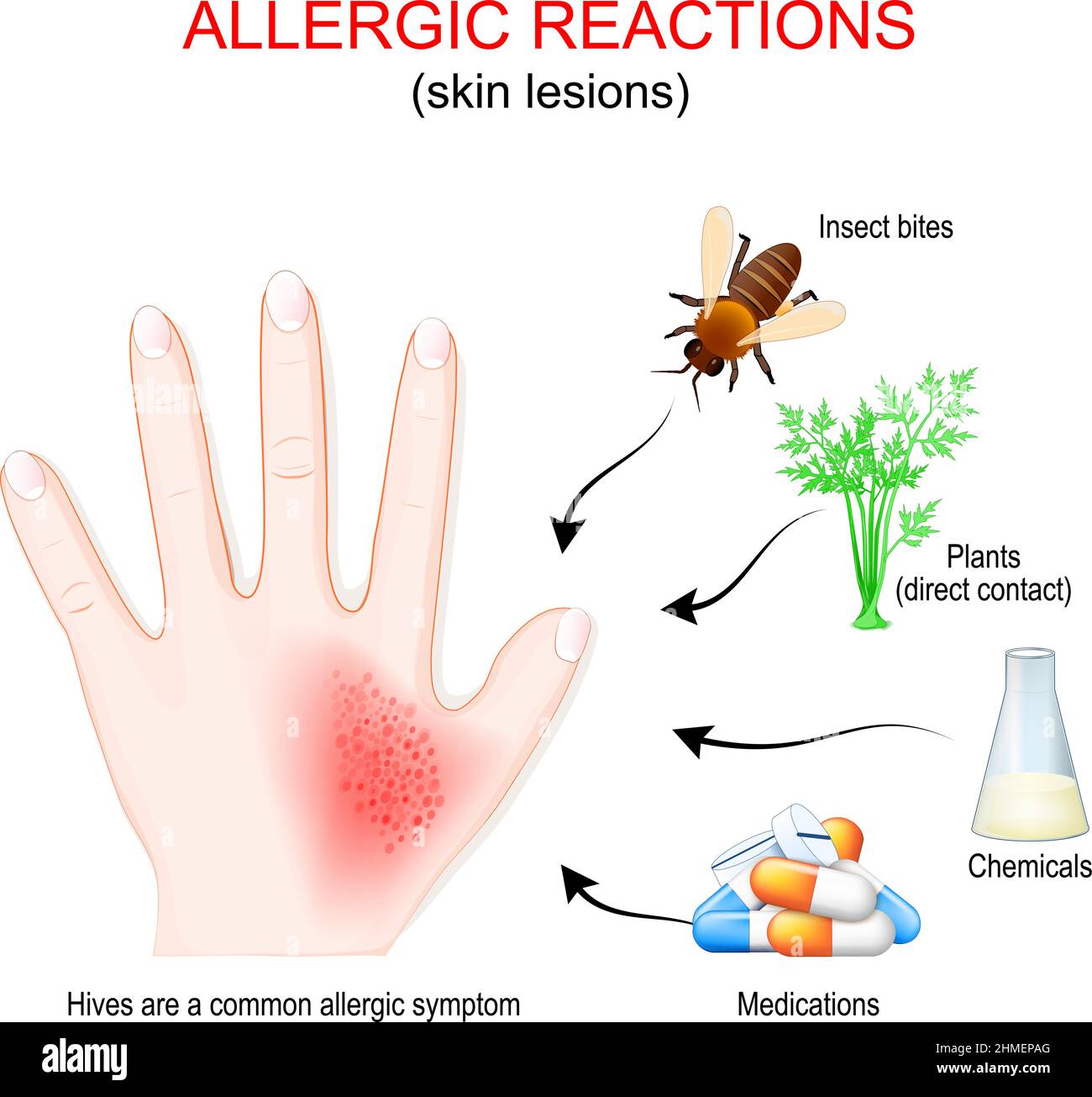 reazione allergica e lesioni cutanee. Mano umana con rash cutaneo o orticaria. Allergeni che hanno causato allergia: Farmaci, prodotti chimici, contatto diretto Illustrazione Vettoriale