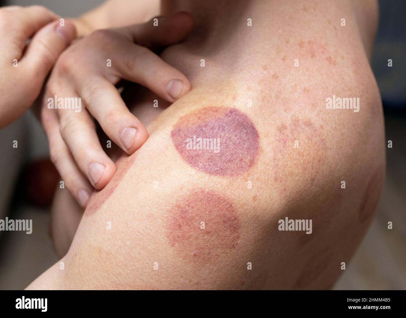 Ematoma sulle spalle dell'uomo dopo sessione di lattine sottovuoto. Segni di sangue dopo aver preso cinese terapia di cupping Foto Stock