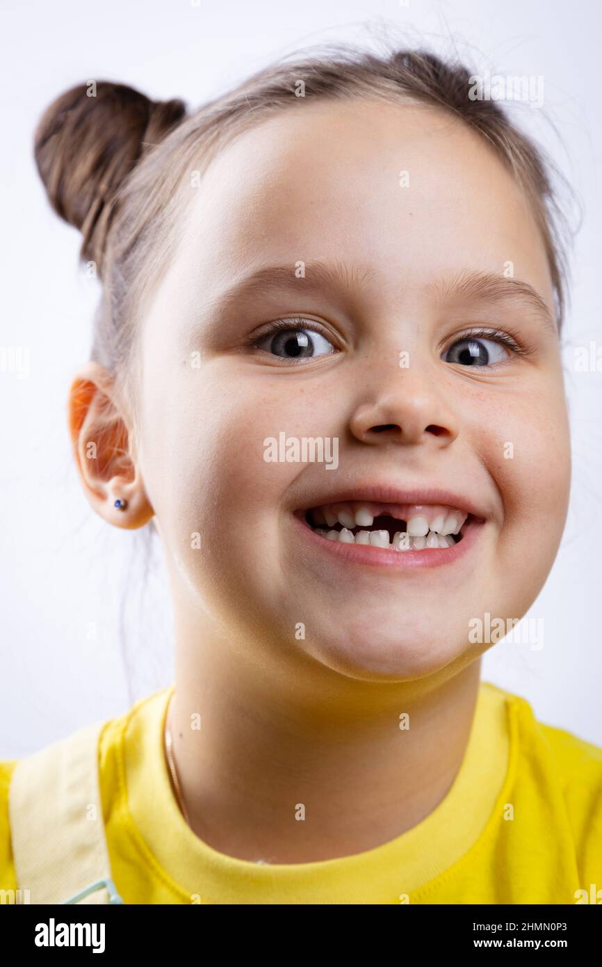 Faccia della bambina sorridente con la bocca aperta che mostra il dente del latte anteriore mancante in t-shirt gialla su sfondo bianco. Sostituzione dei primi denti. Andare a. Foto Stock