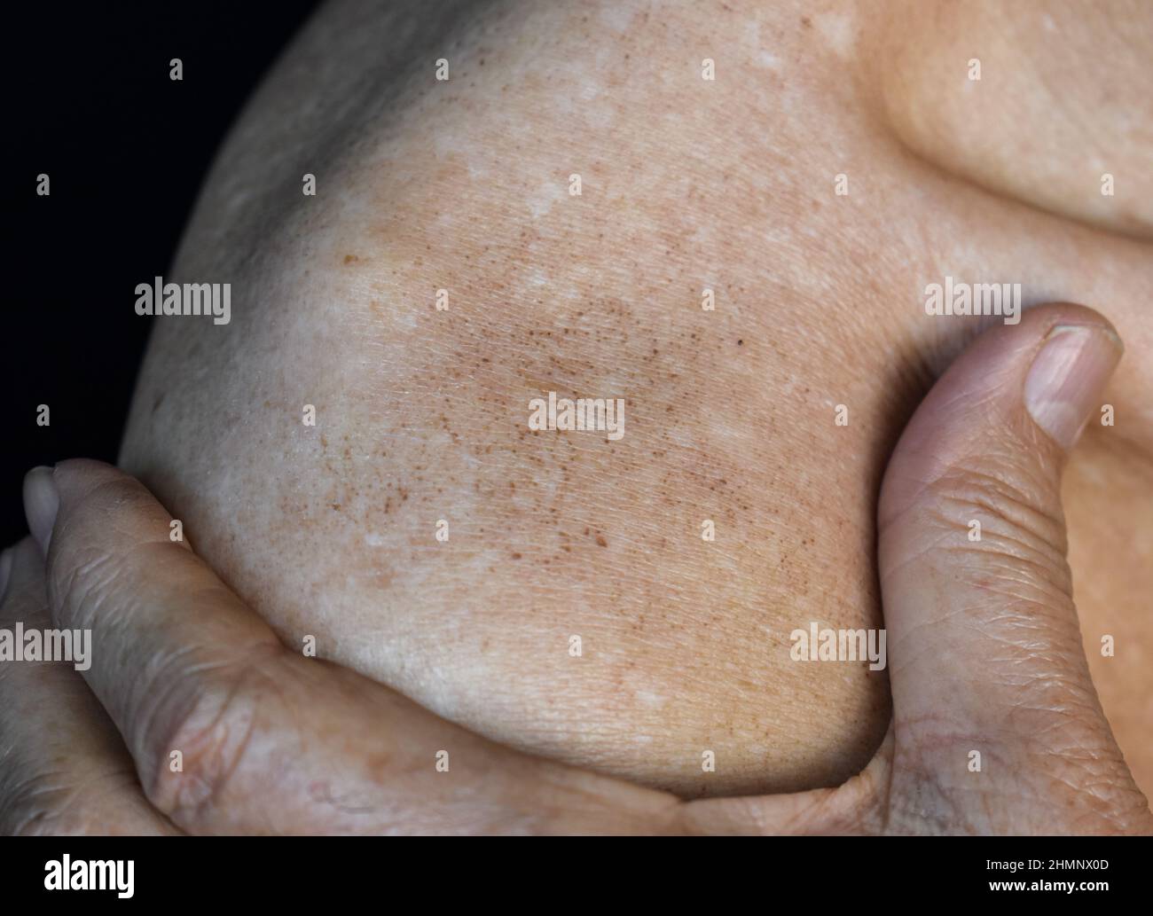 Macchie di età sul corpo dell'anziano asiatico. Sono macchie brune, grigie o nere e anche chiamate macchie di fegato, lentigine senile, lentigine solari, o macchie di sole Foto Stock