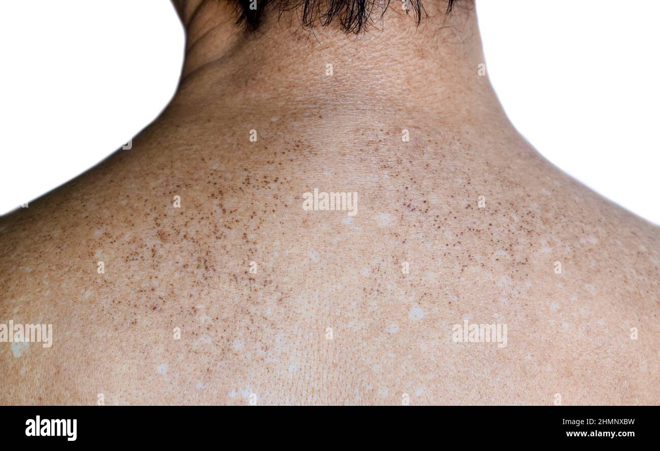 Macchie di età e macchie bianche sulla parte superiore posteriore dell'anziano asiatico. Le macchie di età sono marrone, grigio, o macchie nere e anche chiamato macchie di fegato, lentigine senile, s Foto Stock