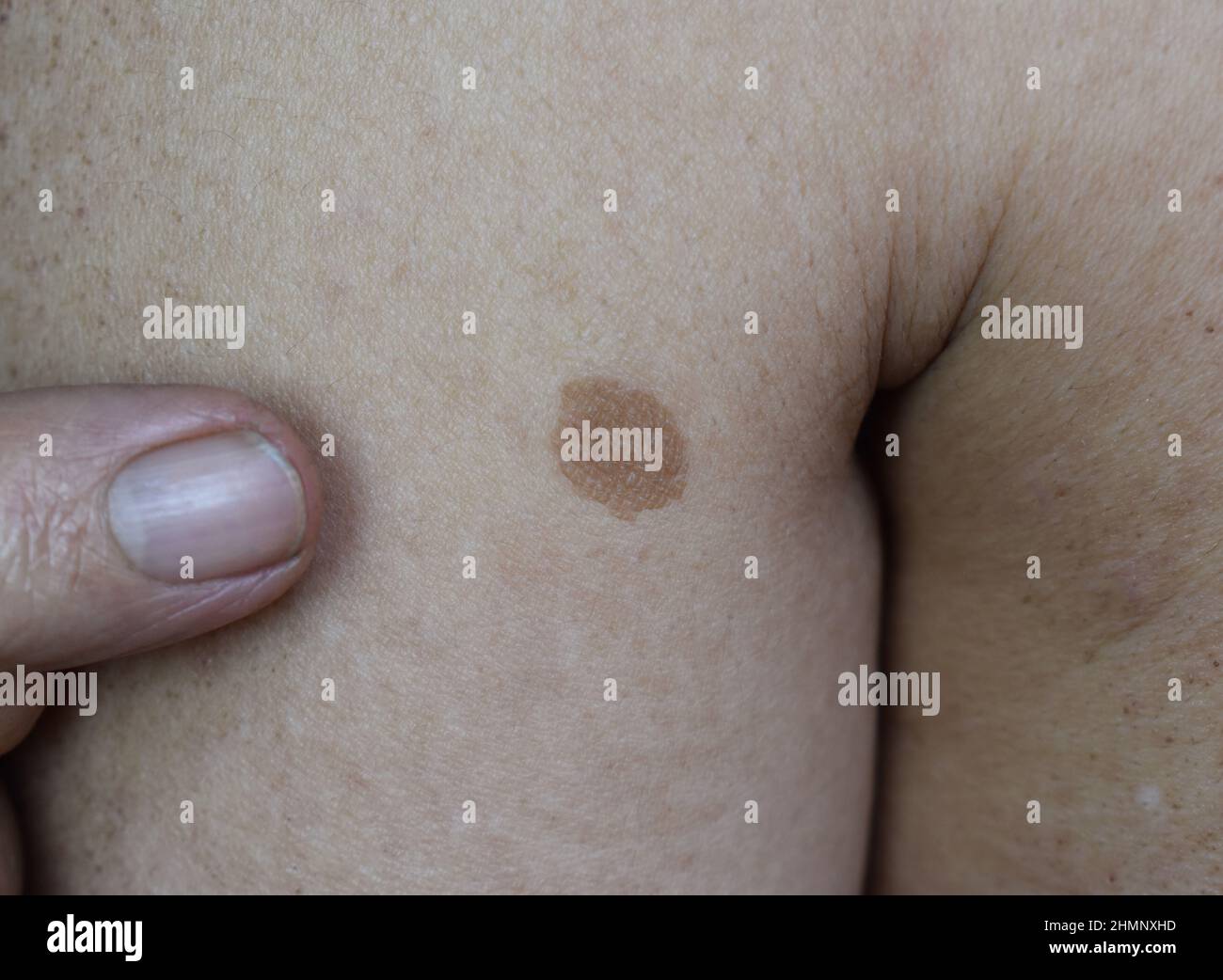 Punto di età o nevo sul braccio dell'anziano asiatico. Si tratta di macchie marroni, grigie o nere, dette macchie di fegato, lentigine senili, lentigine solari o spo solare Foto Stock